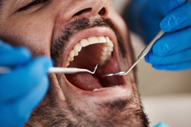 Best Emergency Root Canal Treatment in Blacksburg, SC