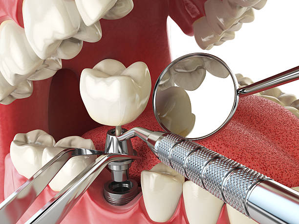 Best Emergency Dental Care for Broken or Chipped Teeth in Blacksburg, SC
